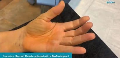 Thumb replaced with a BioPro® Modular Thumb Implant