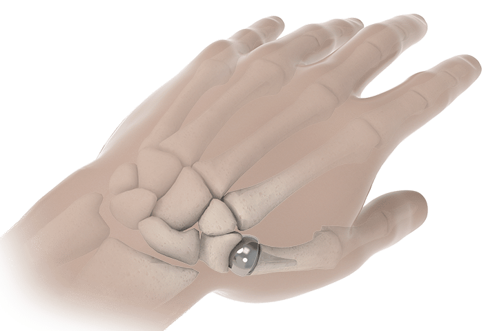 Treatment Options Arthritis Of The Thumb treatment-options-arthritis-of-the-thumb