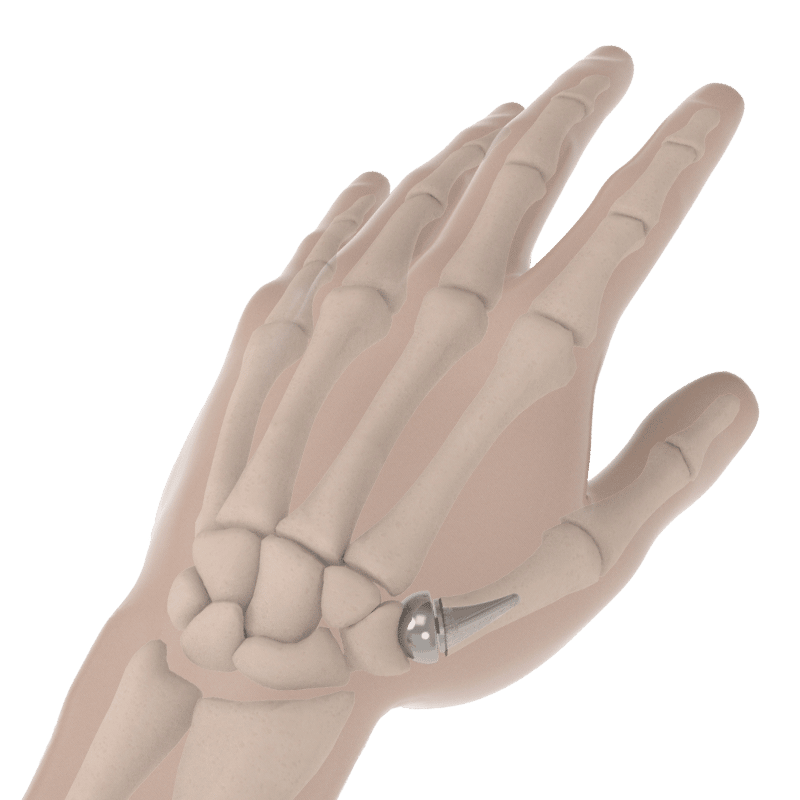 modular-thumb-implant-arthritis-of-the-thumb