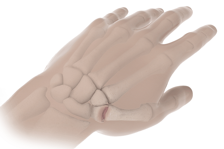 arthritis thumb