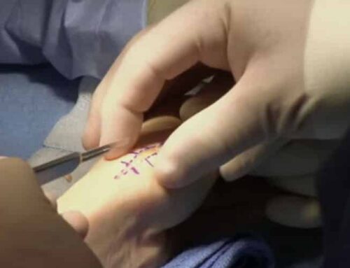 BioPro Modular Thumb Implant Procedure